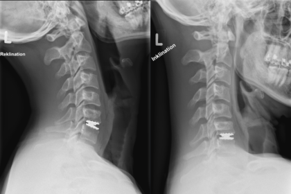 The Basics of Disc Replacement Surgery and Common Questions
