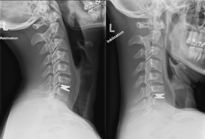 The Basics of Disc Replacement Surgery and Common Questions